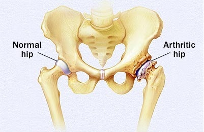 bol u kuku s lijeve strane liječenje osteoartritisa stupnja 4
