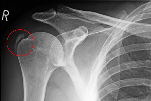 diferencijalna dijagnoza boli u ramenom zglobu artroza hrane koljena pomiješa
